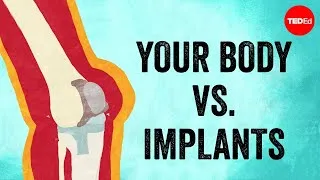 Your body vs. implants - Kaitlyn Sadtler