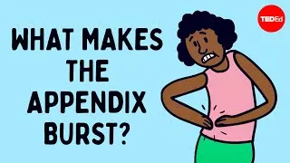 What does appendix pain feel like? - David R. Flum