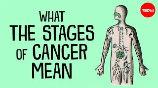 How do doctors determine what stage of cancer you have? - Hyunsoo Joshua No and Trudy Wu